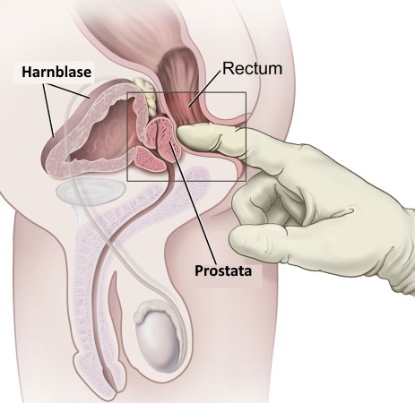 Untersuchung der Prostata