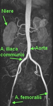 Arterien des Bauchraumes und Beckens (Aorta)