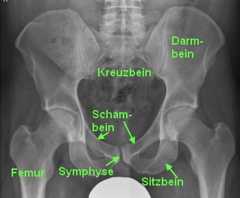 Becken-Knochen (os ileum, os pubis, os isschii)