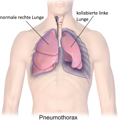 Pneumothorax der Lunge